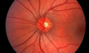 人类智能化里程碑，谷歌人工智能学会诊断眼疾